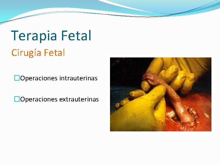 Terapia Fetal Cirugía Fetal �Operaciones intrauterinas �Operaciones extrauterinas 