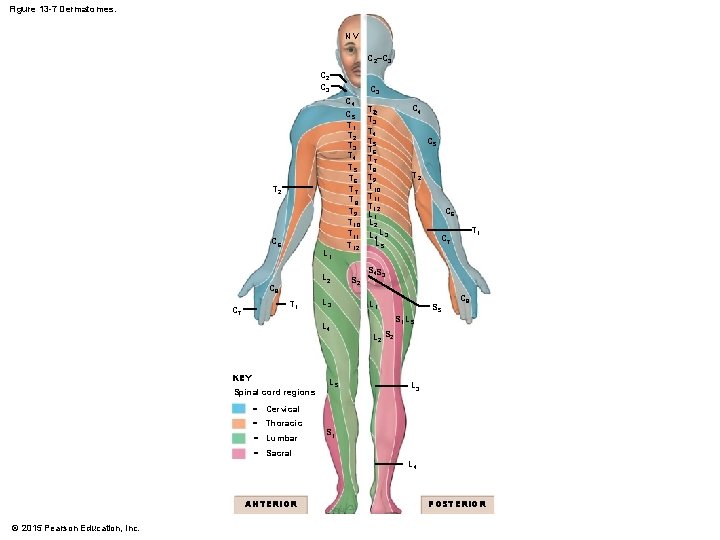 Figure 13 -7 Dermatomes. NV C 2–C 3 C 2 C 3 T 2