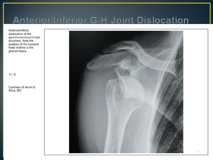 Anterior/Inferior G-H Joint Dislocation 55 