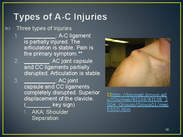 Types of A-C Injuries Three types of Injuries 1. _____: A-C ligament is partially