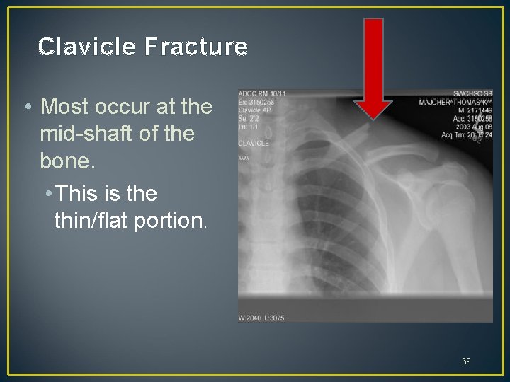 Clavicle Fracture • Most occur at the mid-shaft of the bone. • This is