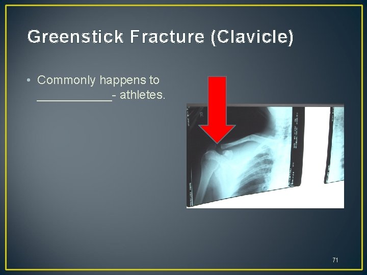 Greenstick Fracture (Clavicle) • Commonly happens to ______- athletes. 71 