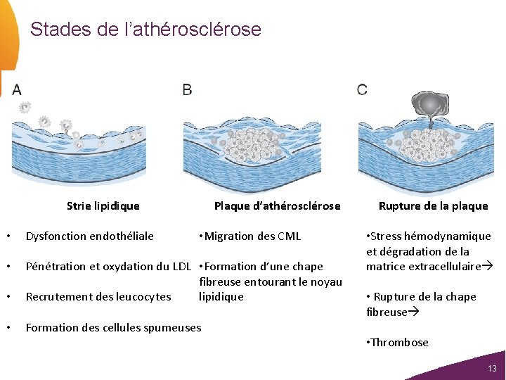 Stades de l’athérosclérose Strie lipidique Plaque d’athérosclérose • Dysfonction endothéliale • Migration des CML