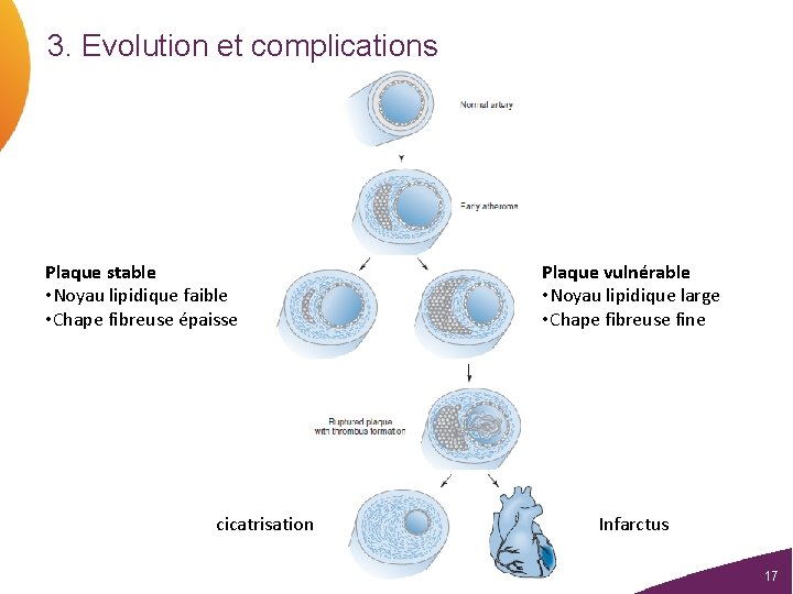 3. Evolution et complications Plaque stable • Noyau lipidique faible • Chape fibreuse épaisse