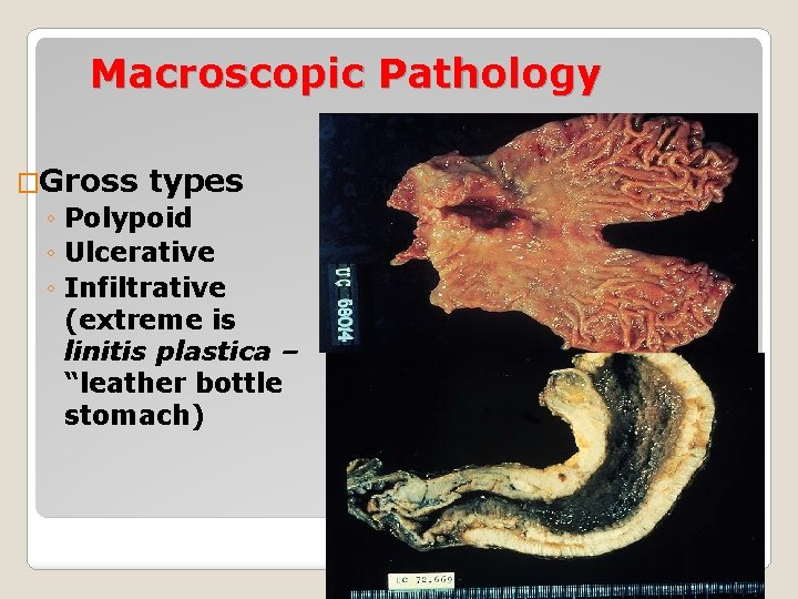 Macroscopic Pathology �Gross types ◦ Polypoid ◦ Ulcerative ◦ Infiltrative (extreme is linitis plastica