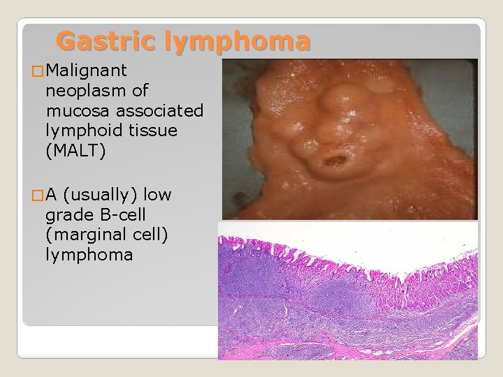 Gastric lymphoma � Malignant neoplasm of mucosa associated lymphoid tissue (MALT) �A (usually) low