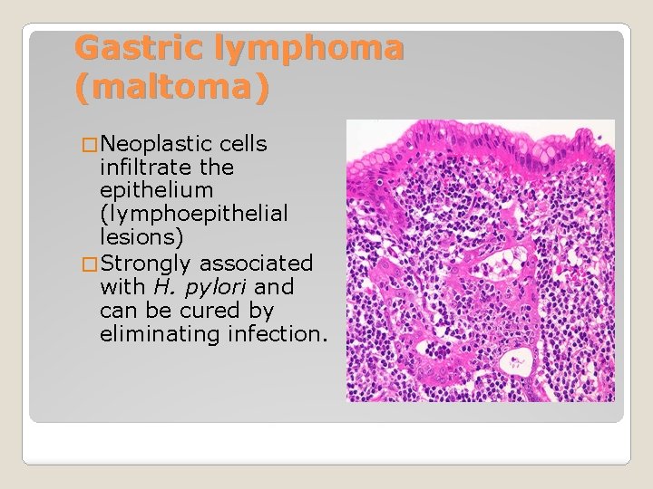 Gastric lymphoma (maltoma) � Neoplastic cells infiltrate the epithelium (lymphoepithelial lesions) � Strongly associated