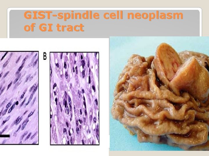 GIST-spindle cell neoplasm of GI tract 