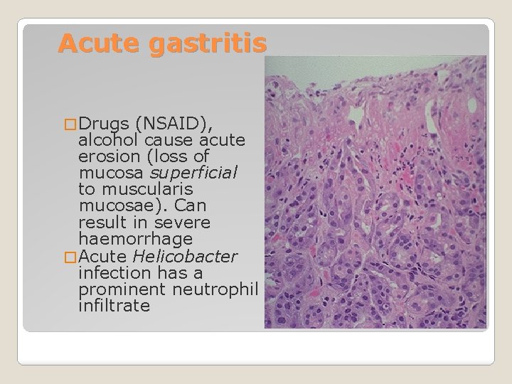 Acute gastritis � Drugs (NSAID), alcohol cause acute erosion (loss of mucosa superficial to