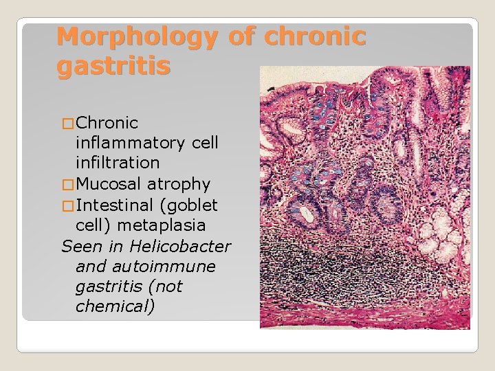 Morphology of chronic gastritis � Chronic inflammatory cell infiltration � Mucosal atrophy � Intestinal