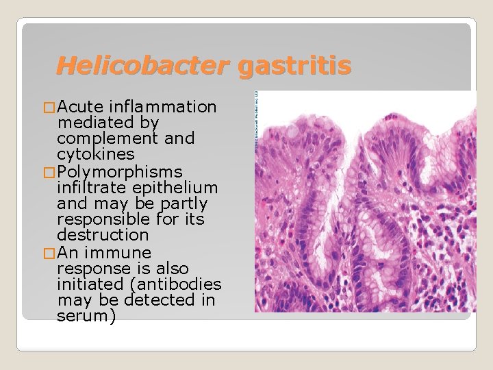 Helicobacter gastritis � Acute inflammation mediated by complement and cytokines � Polymorphisms infiltrate epithelium