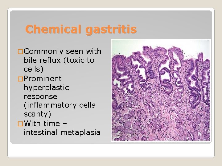 Chemical gastritis � Commonly seen with bile reflux (toxic to cells) � Prominent hyperplastic