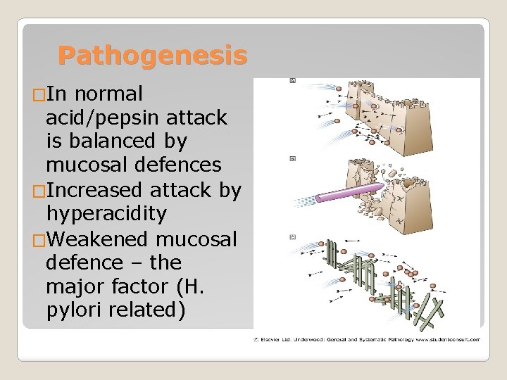 Pathogenesis �In normal acid/pepsin attack is balanced by mucosal defences �Increased attack by hyperacidity