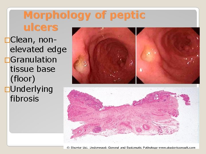 Morphology of peptic ulcers �Clean, nonelevated edge �Granulation tissue base (floor) �Underlying fibrosis 