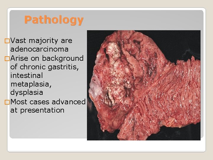 Pathology � Vast majority are adenocarcinoma � Arise on background of chronic gastritis, intestinal