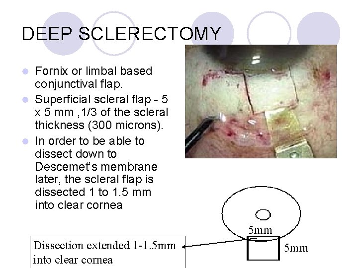 DEEP SCLERECTOMY Fornix or limbal based conjunctival flap. l Superficial scleral flap - 5
