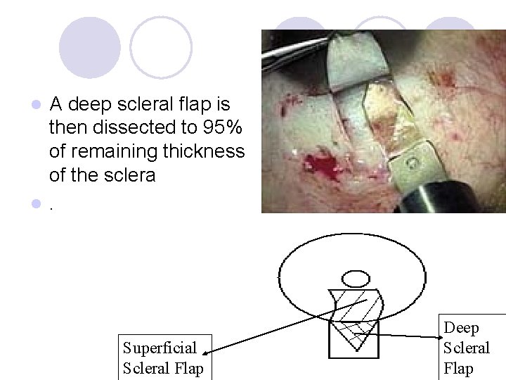 A deep scleral flap is then dissected to 95% of remaining thickness of the