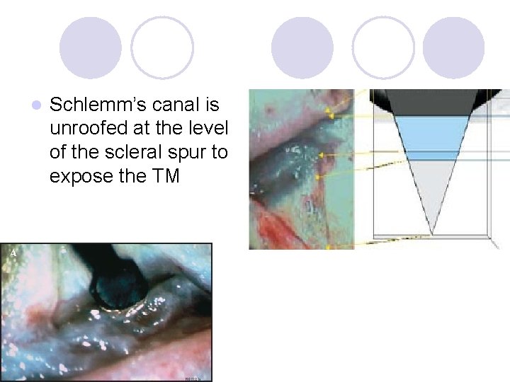 l Schlemm’s canal is unroofed at the level of the scleral spur to expose