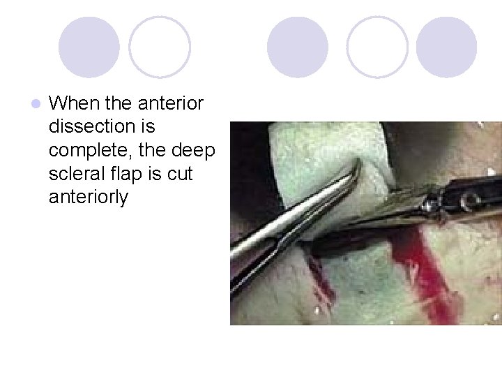 l When the anterior dissection is complete, the deep scleral flap is cut anteriorly