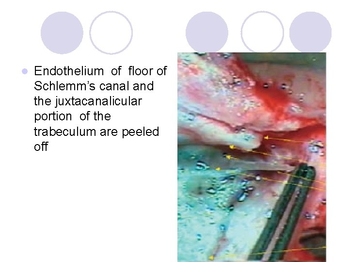 l Endothelium of floor of Schlemm’s canal and the juxtacanalicular portion of the trabeculum