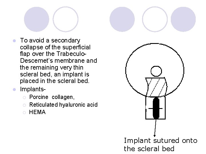 To avoid a secondary collapse of the superficial flap over the Trabeculo. Descemet’s membrane