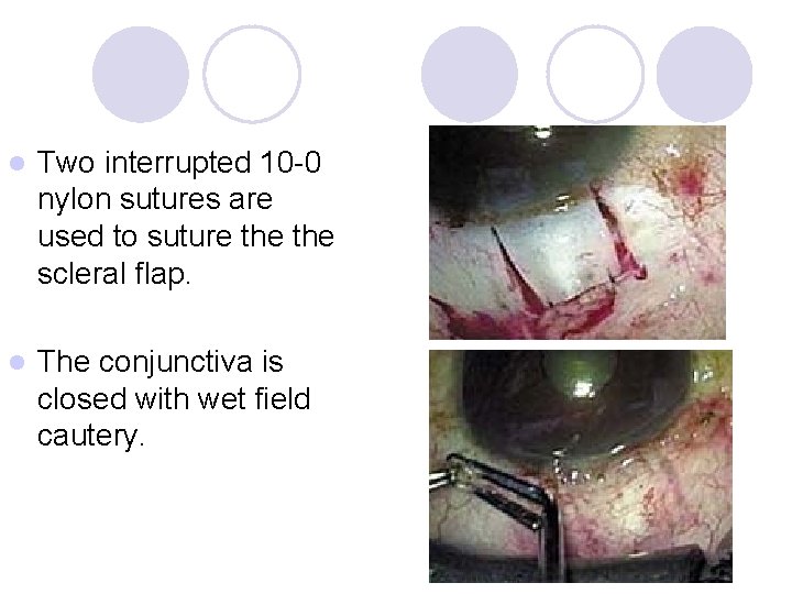 l Two interrupted 10 -0 nylon sutures are used to suture the scleral flap.