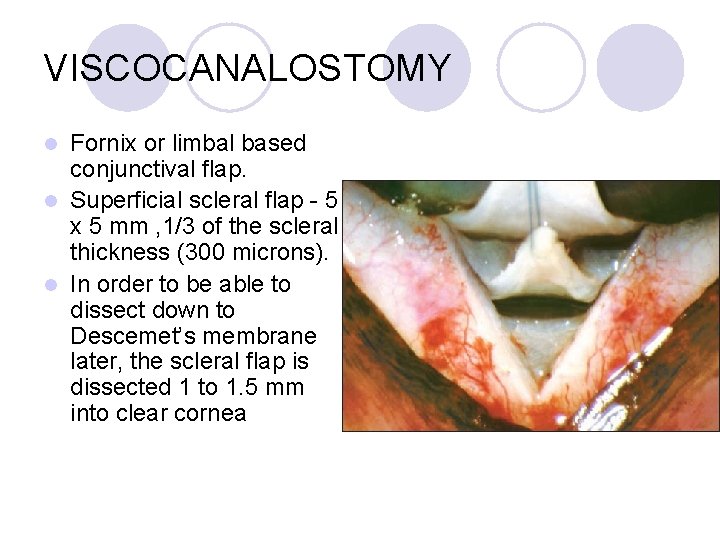 VISCOCANALOSTOMY Fornix or limbal based conjunctival flap. l Superficial scleral flap - 5 x