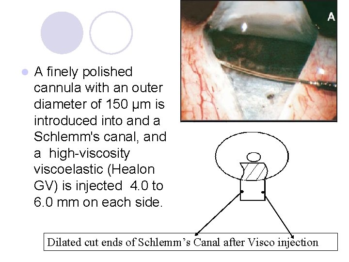 l A finely polished cannula with an outer diameter of 150 µm is introduced