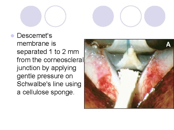 l Descemet's membrane is separated 1 to 2 mm from the corneoscleral junction by