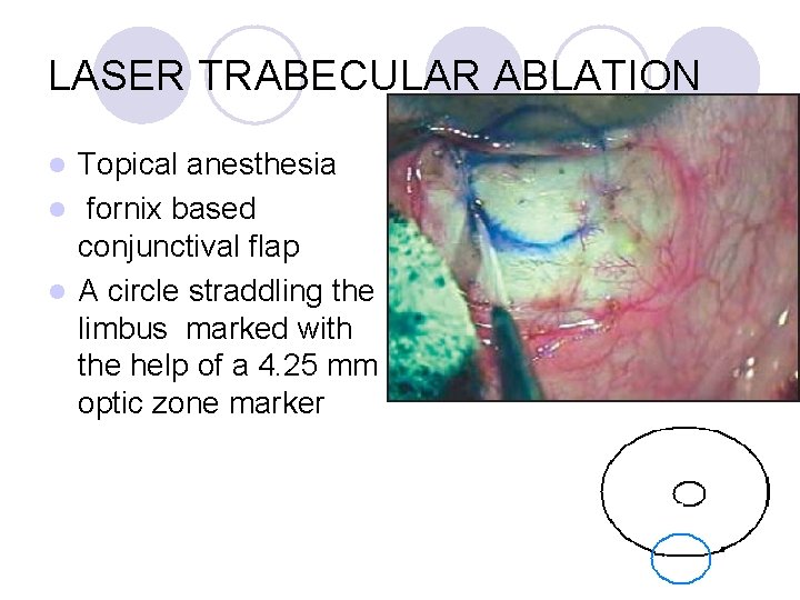 LASER TRABECULAR ABLATION Topical anesthesia l fornix based conjunctival flap l A circle straddling