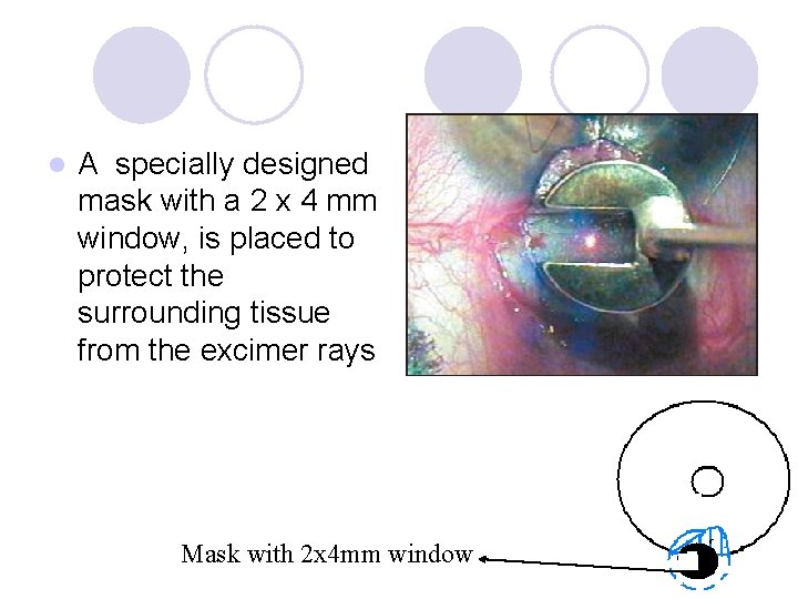 l A specially designed mask with a 2 x 4 mm window, is placed