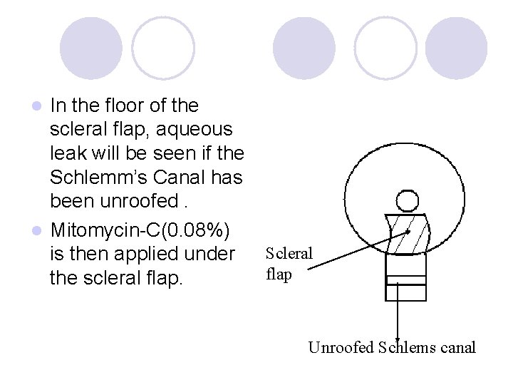 In the floor of the scleral flap, aqueous leak will be seen if the