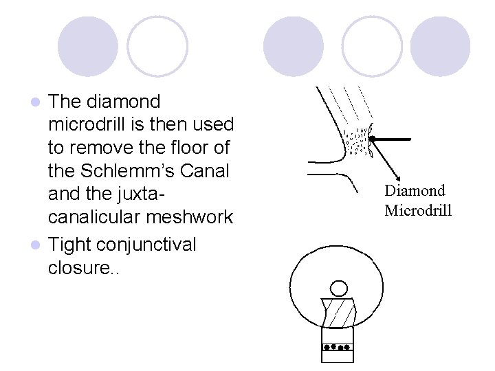 The diamond microdrill is then used to remove the floor of the Schlemm’s Canal
