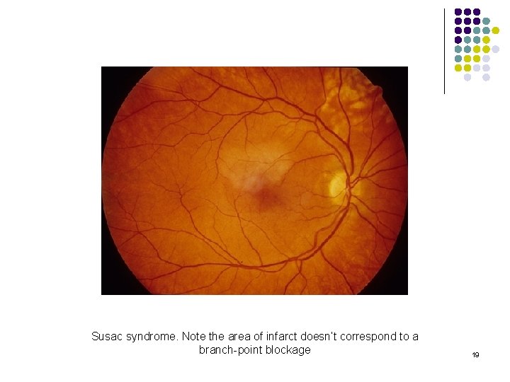 Susac syndrome. Note the area of infarct doesn’t correspond to a branch-point blockage 19