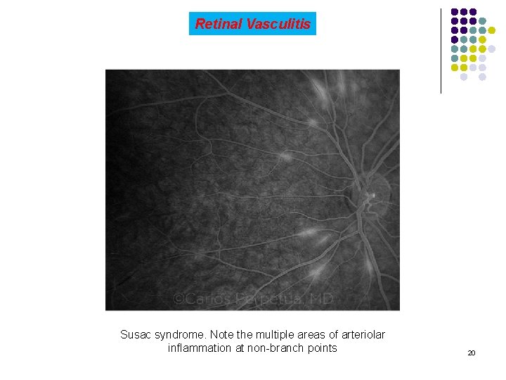 Retinal Vasculitis Susac syndrome. Note the multiple areas of arteriolar inflammation at non-branch points