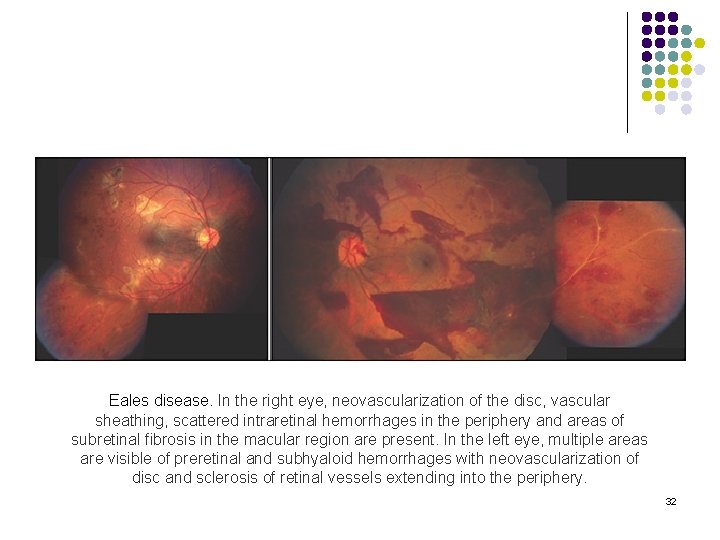 Eales disease. In the right eye, neovascularization of the disc, vascular sheathing, scattered intraretinal