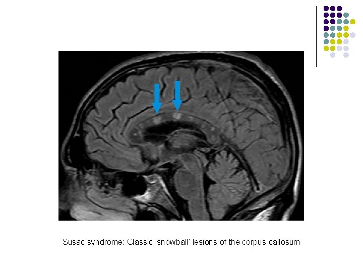 Susac syndrome: Classic ‘snowball’ lesions of the corpus callosum 