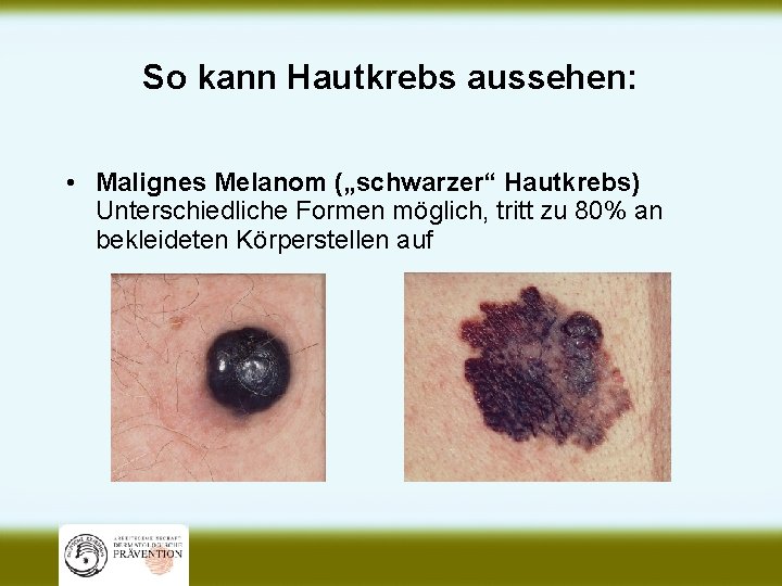 So kann Hautkrebs aussehen: • Malignes Melanom („schwarzer“ Hautkrebs) Unterschiedliche Formen möglich, tritt zu