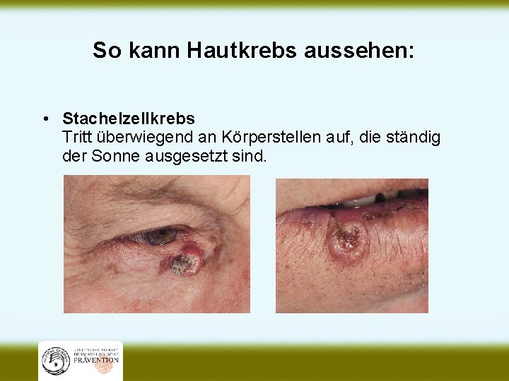 So kann Hautkrebs aussehen: • Stachelzellkrebs Tritt überwiegend an Körperstellen auf, die ständig der