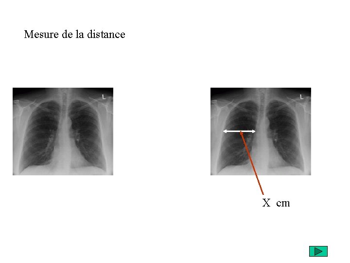 Mesure de la distance X cm 