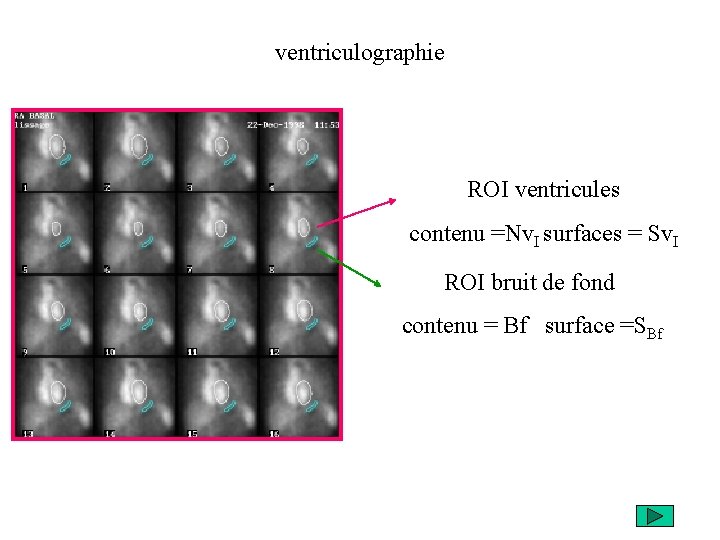 ventriculographie ROI ventricules contenu =Nv. I surfaces = Sv. I ROI bruit de fond