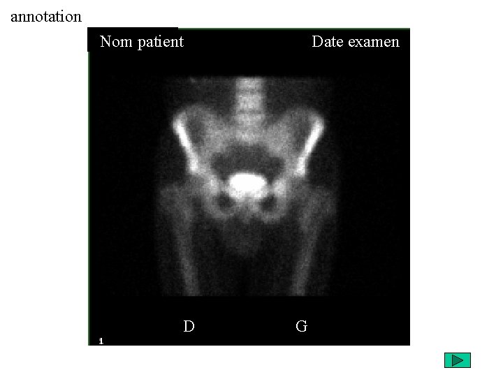 annotation Nom patient D Date examen G 