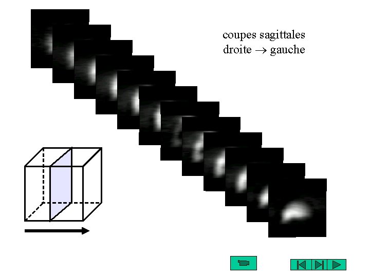 coupes sagittales droite gauche 