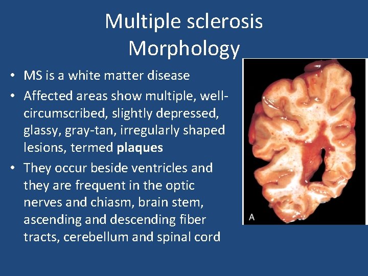 Multiple sclerosis Morphology • MS is a white matter disease • Affected areas show