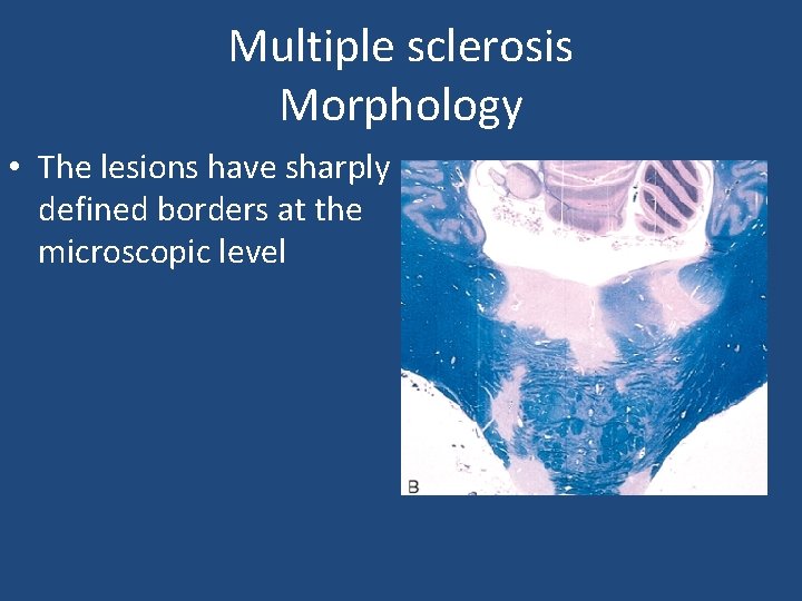 Multiple sclerosis Morphology • The lesions have sharply defined borders at the microscopic level