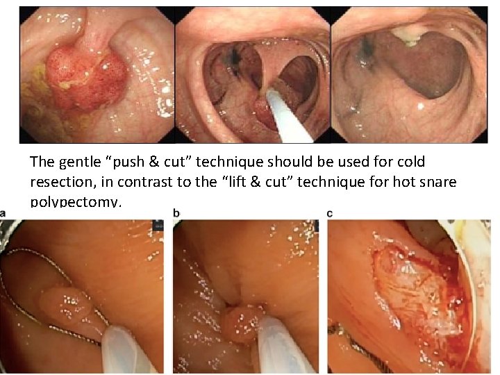 The gentle “push & cut” technique should be used for cold resection, in contrast