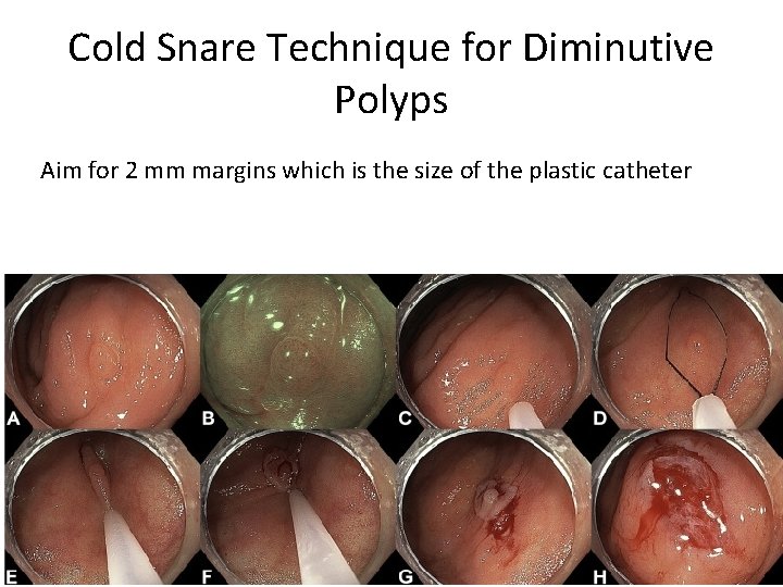 Cold Snare Technique for Diminutive Polyps Aim for 2 mm margins which is the