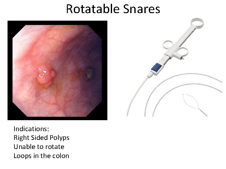 Rotatable Snares Indications: Right Sided Polyps Unable to rotate Loops in the colon 