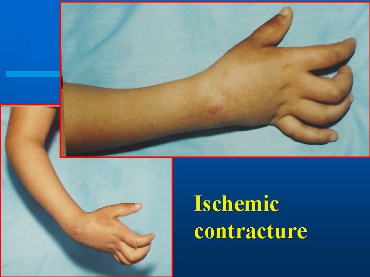 Ischemic contracture 