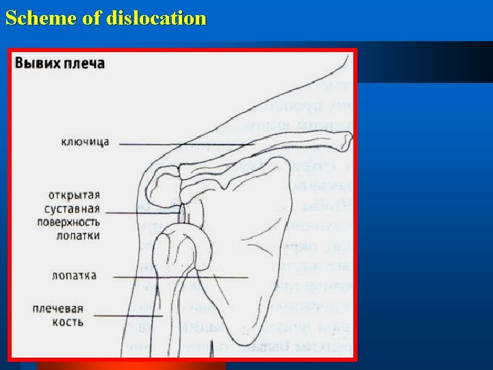 Scheme of dislocation 